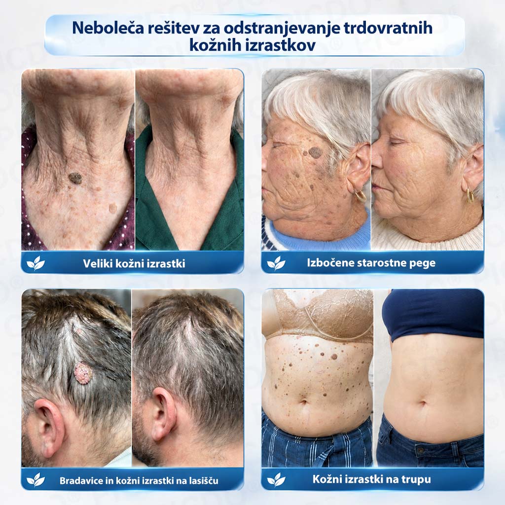 𝐏𝐢𝐜𝐝𝐨®🧑‍⚕️ 𝟕-𝐝𝐧𝐞𝐯𝐧𝐚 𝐤𝐫𝐞𝐦𝐚 𝐩𝐫𝐨𝐭𝐢 𝐤𝐨ž𝐧𝐢𝐦 𝐢𝐳𝐫𝐚𝐬𝐭𝐤𝐨𝐦 & 𝐩𝐢𝐠𝐦𝐞𝐧𝐭𝐧𝐢𝐦 𝐥𝐢𝐬𝐭𝐚𝐦𝐢 (Brezbolestna formula – brez brazgotin)💧