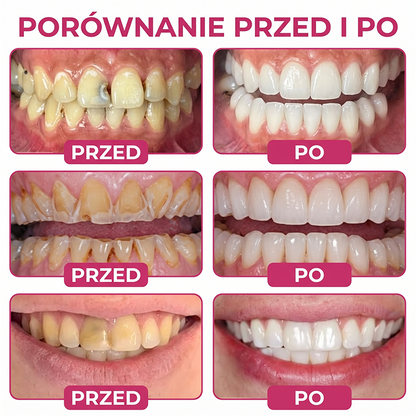Rolimey® DenPerm – Naravni gel za zapolnitev skleninskih defektov pri kariesu🐸