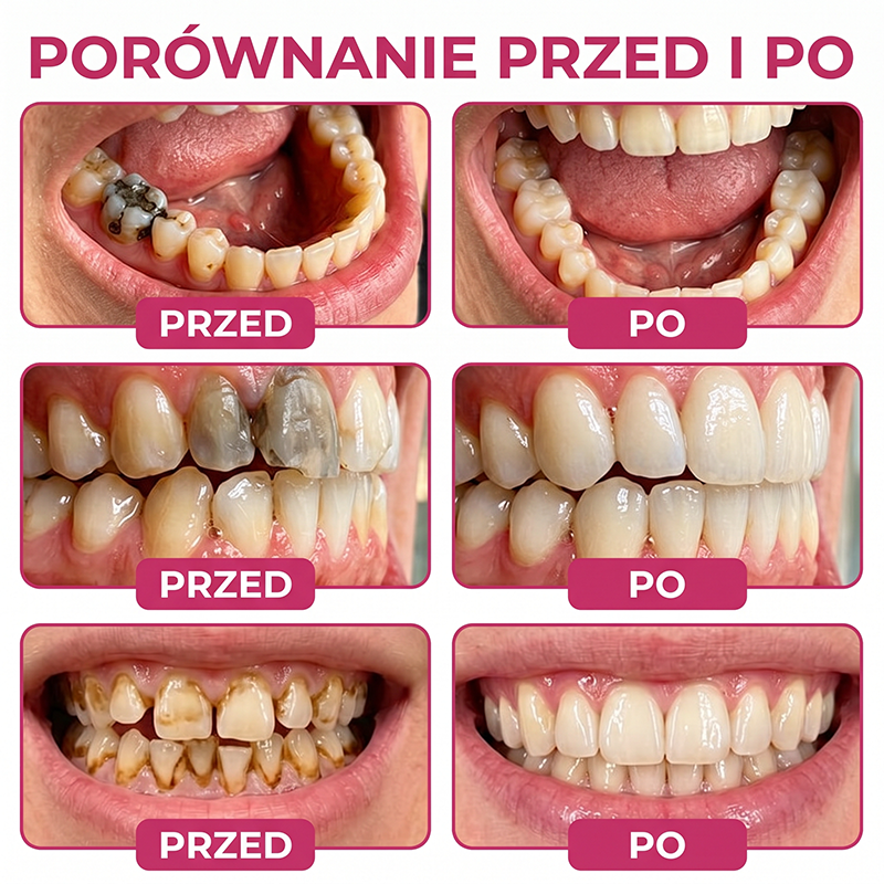 Rolimey® DenPerm – Naravni gel za zapolnitev skleninskih defektov pri kariesu🐸